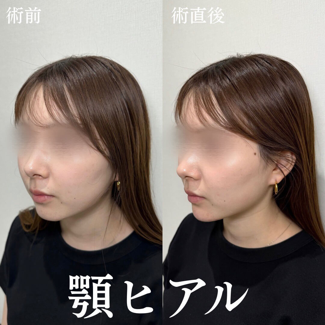 ヒアルロン酸 症例15