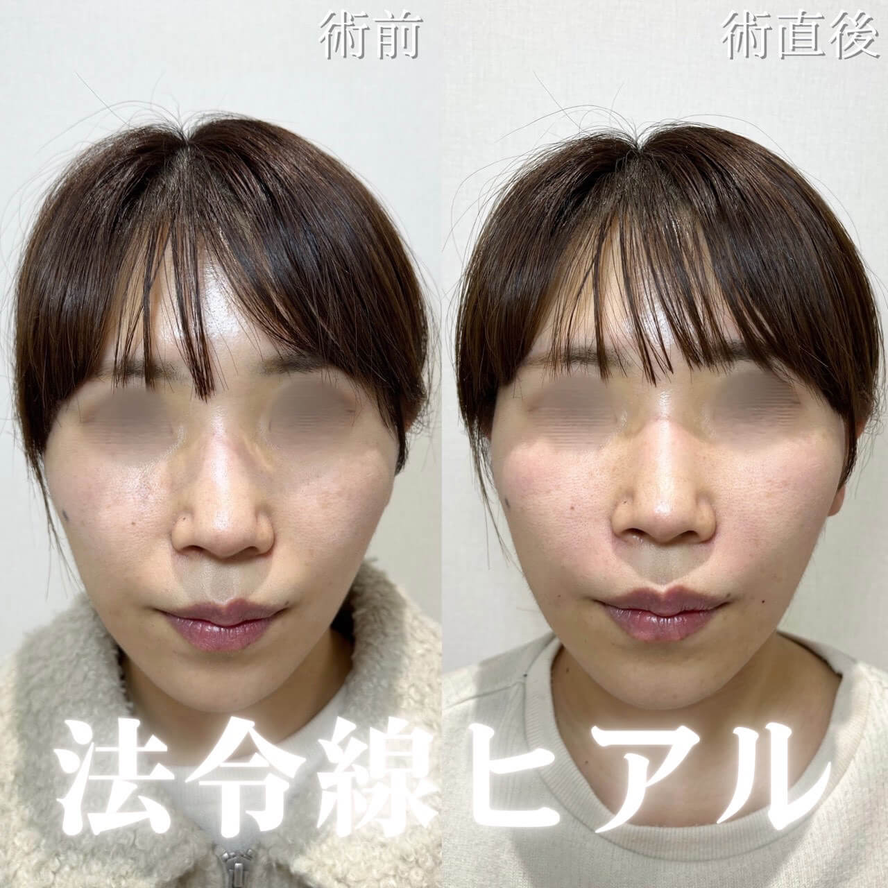 ヒアルロン酸 症例16