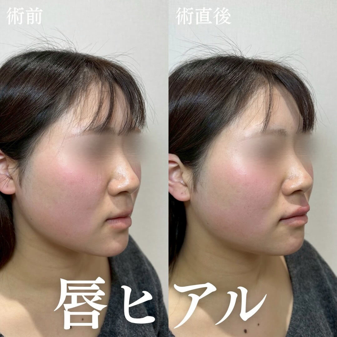 ヒアルロン酸 症例17