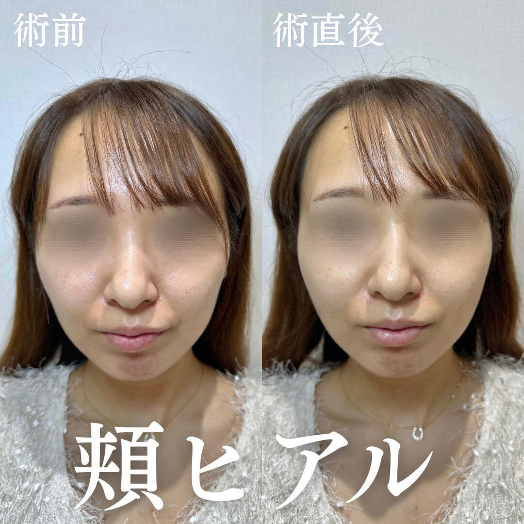 ヒアルロン酸 症例18