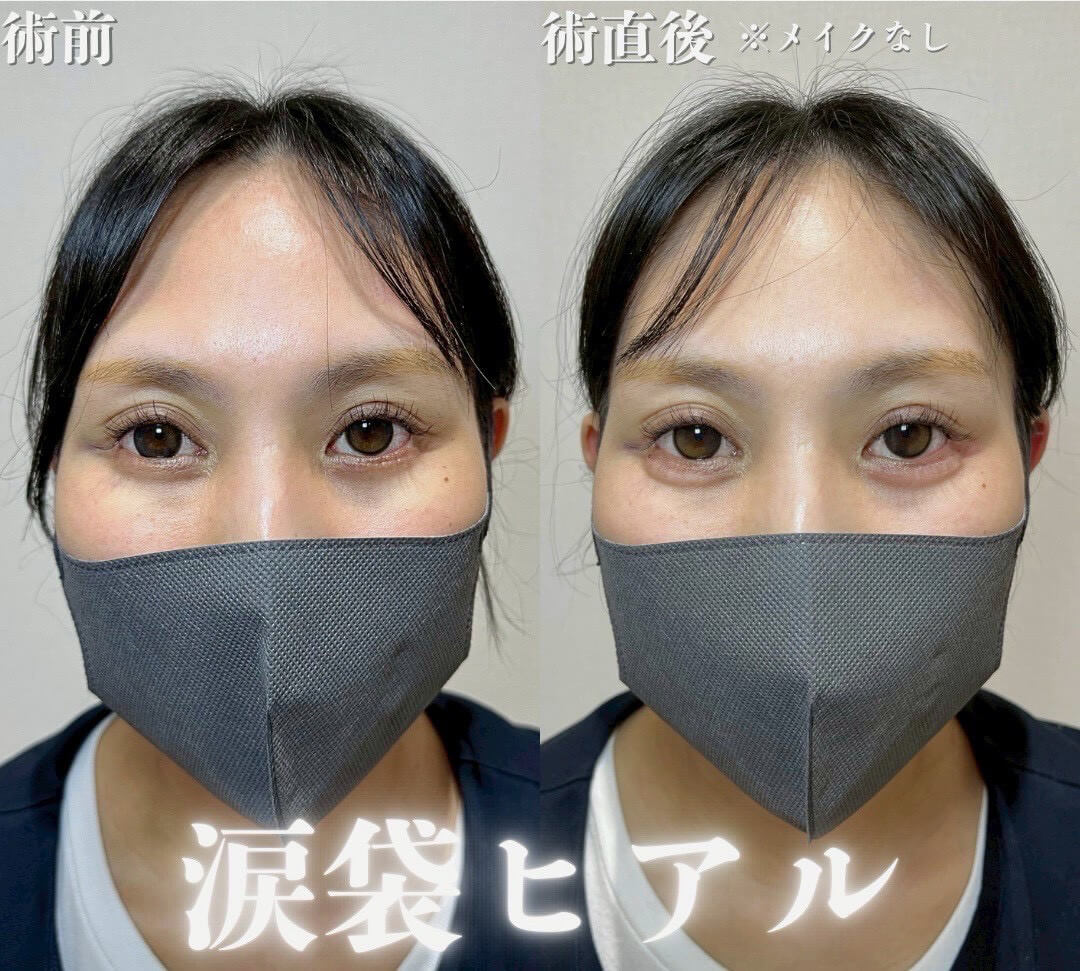 ヒアルロン酸 症例19