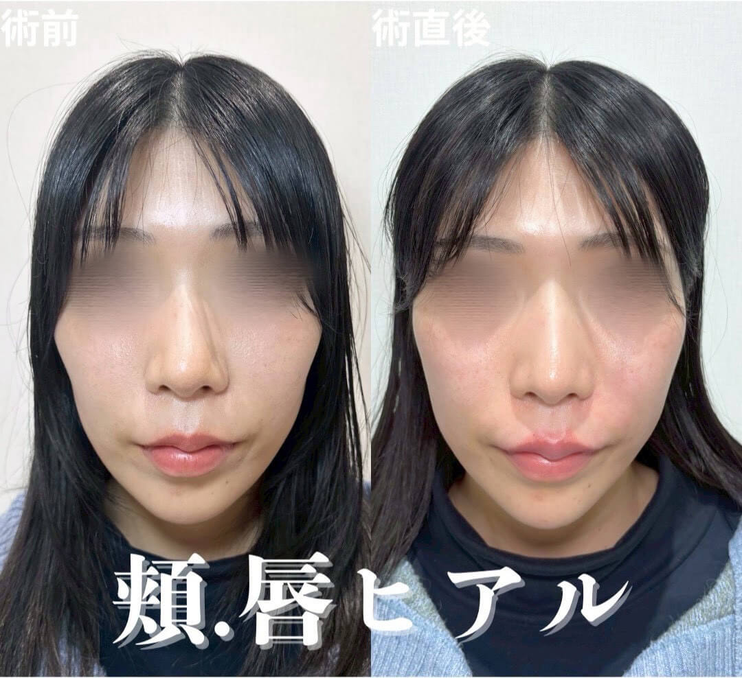 ヒアルロン酸 症例20