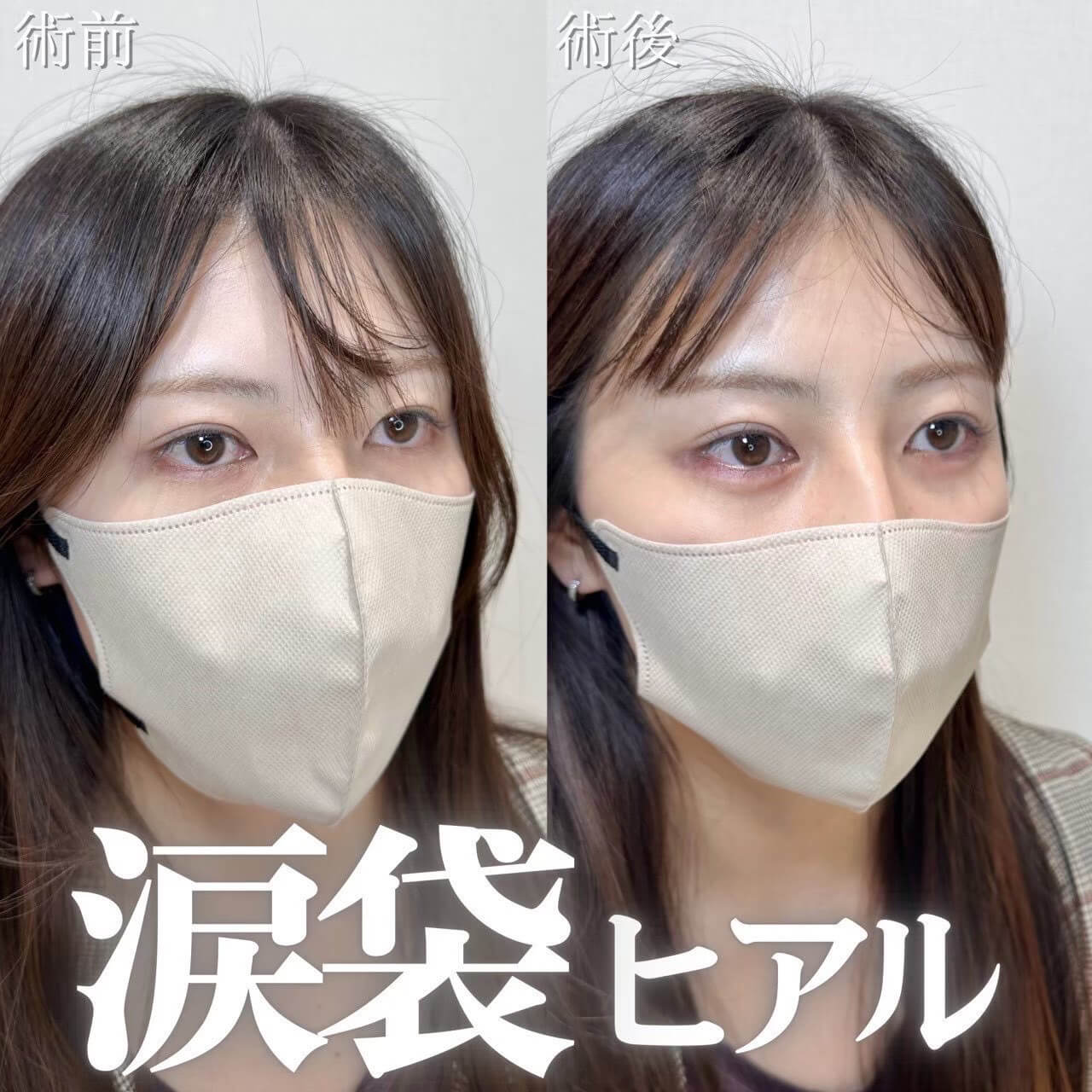 ヒアルロン酸 症例21