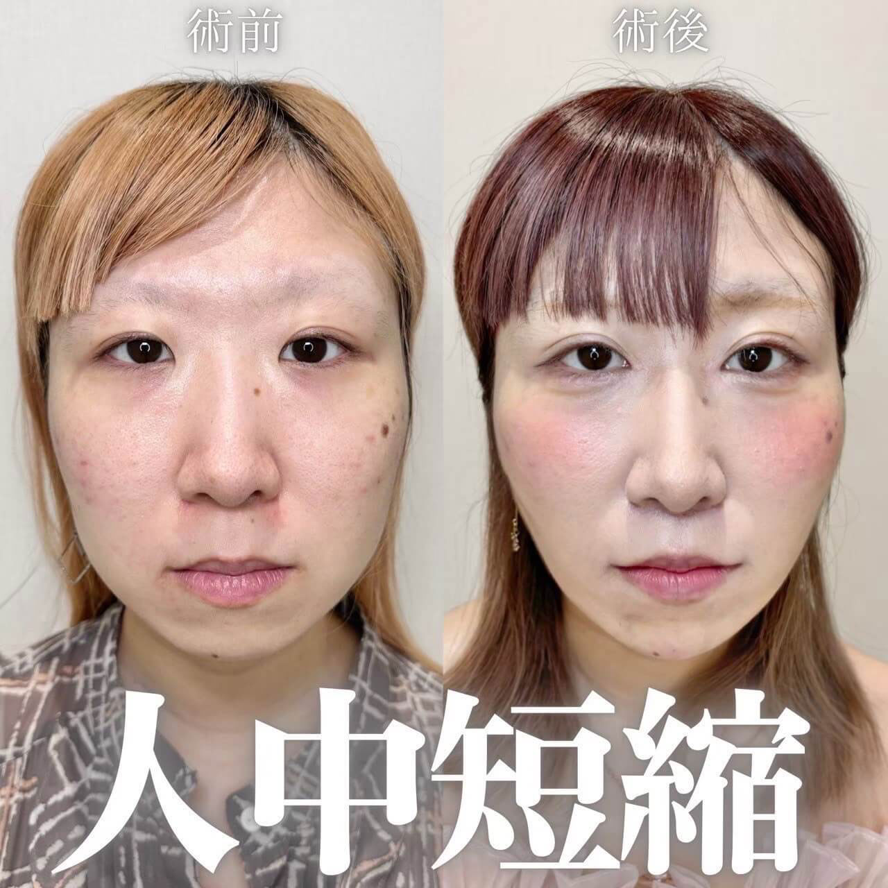 人中短縮 症例06