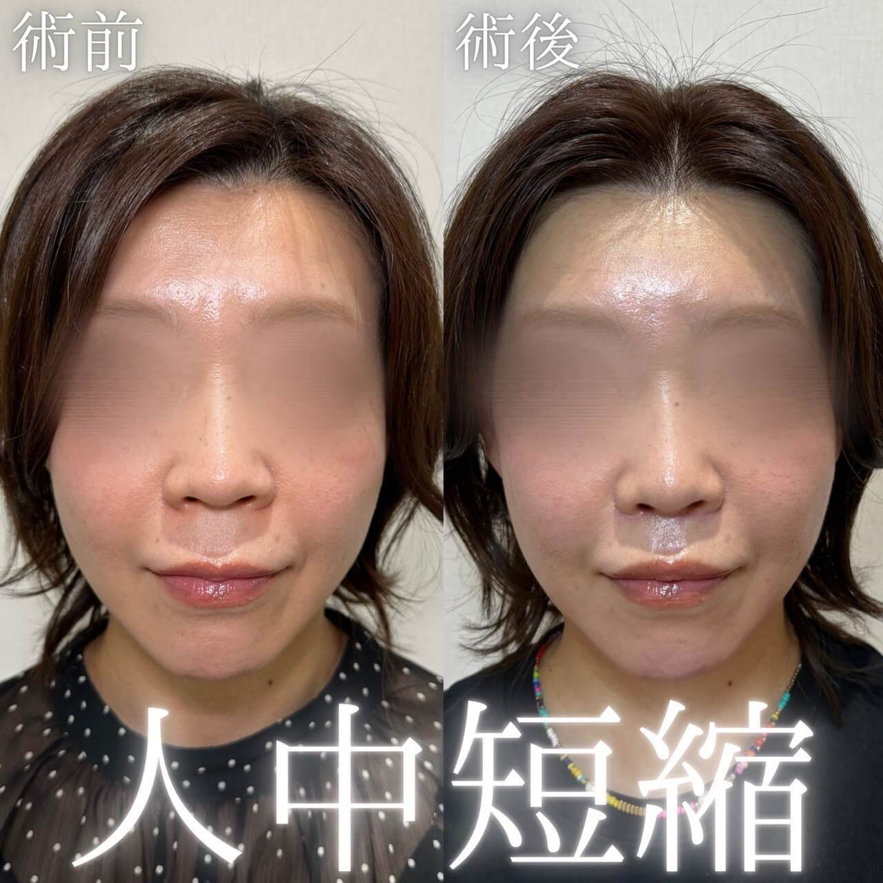 人中短縮 症例07