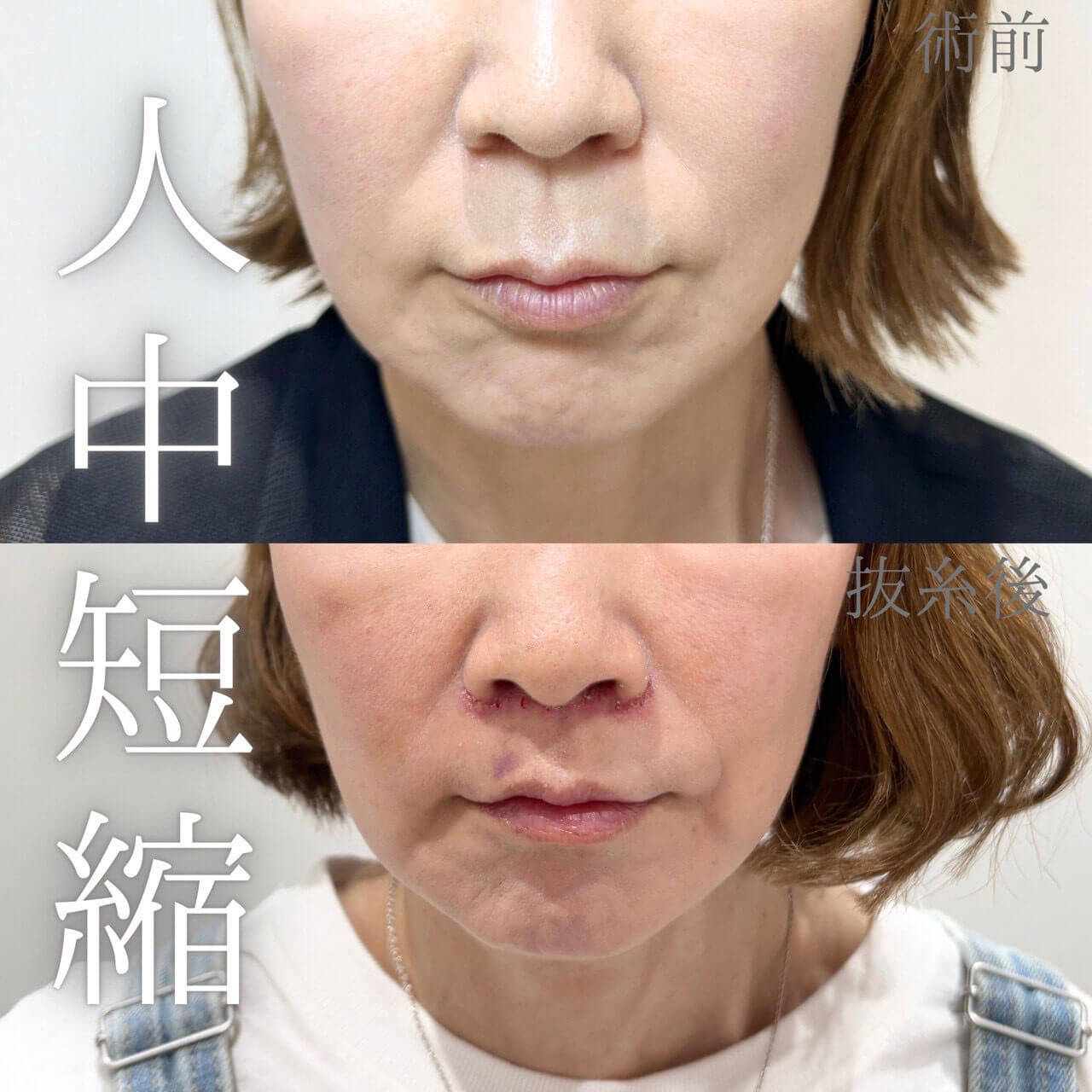 人中短縮 症例08