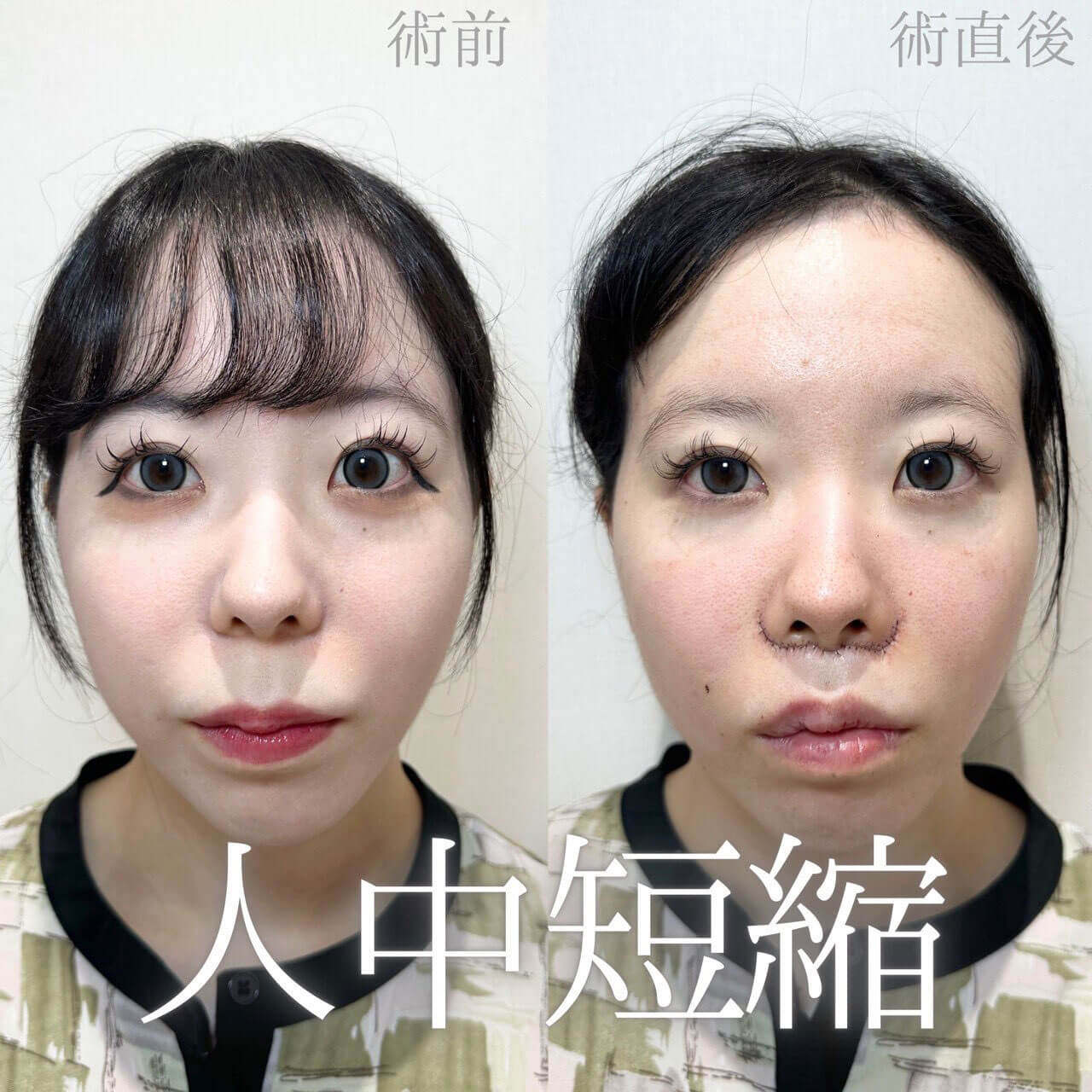 人中短縮 症例09