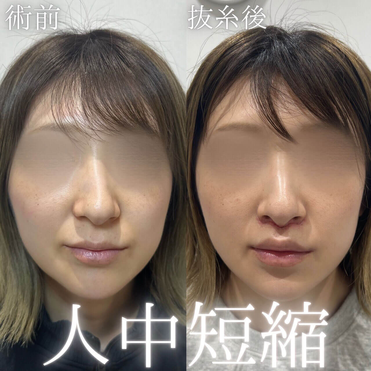 人中短縮 症例10