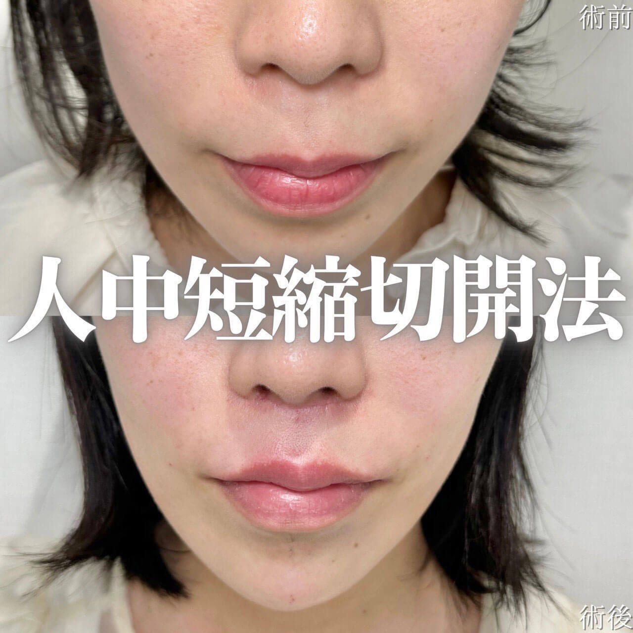 人中短縮 症例11