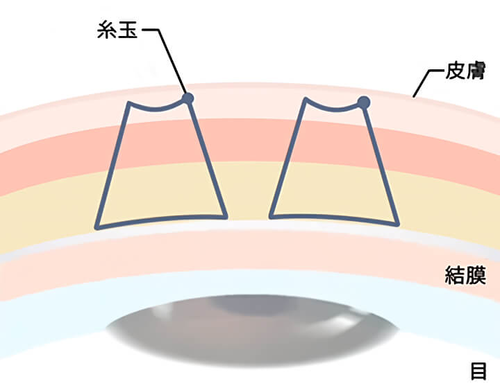 4点留め