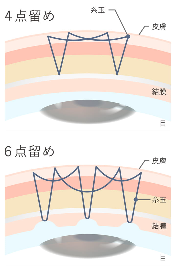 線留め