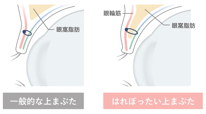 一般的な上まぶた・はれぼったい上まぶた